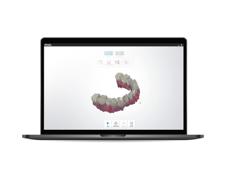 digitaler Abdruck mit Mundscanner